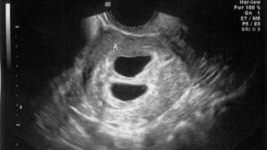 ultrasound-4-weeks