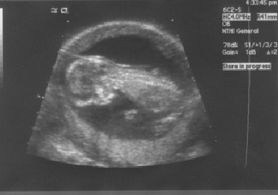 Week 13 Pregnancy Ultrasound Picture - Pregnancy Calendars